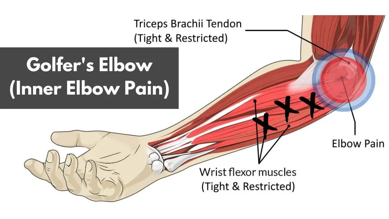 golfers elbow